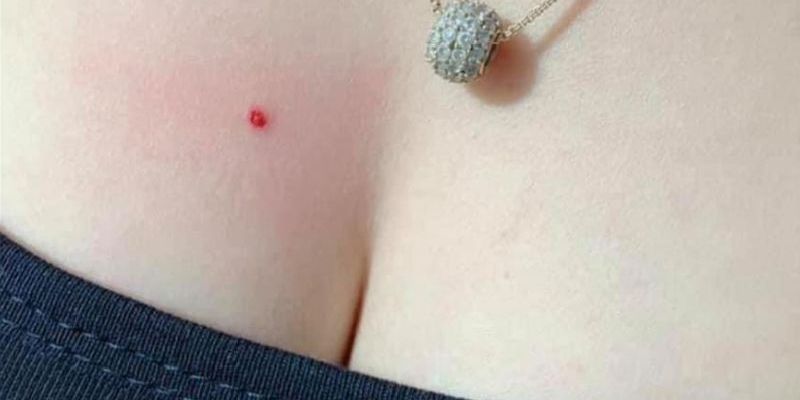 Ý nghĩa nốt ruồi son